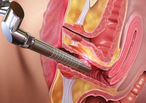Laser vaginal rejuvenation